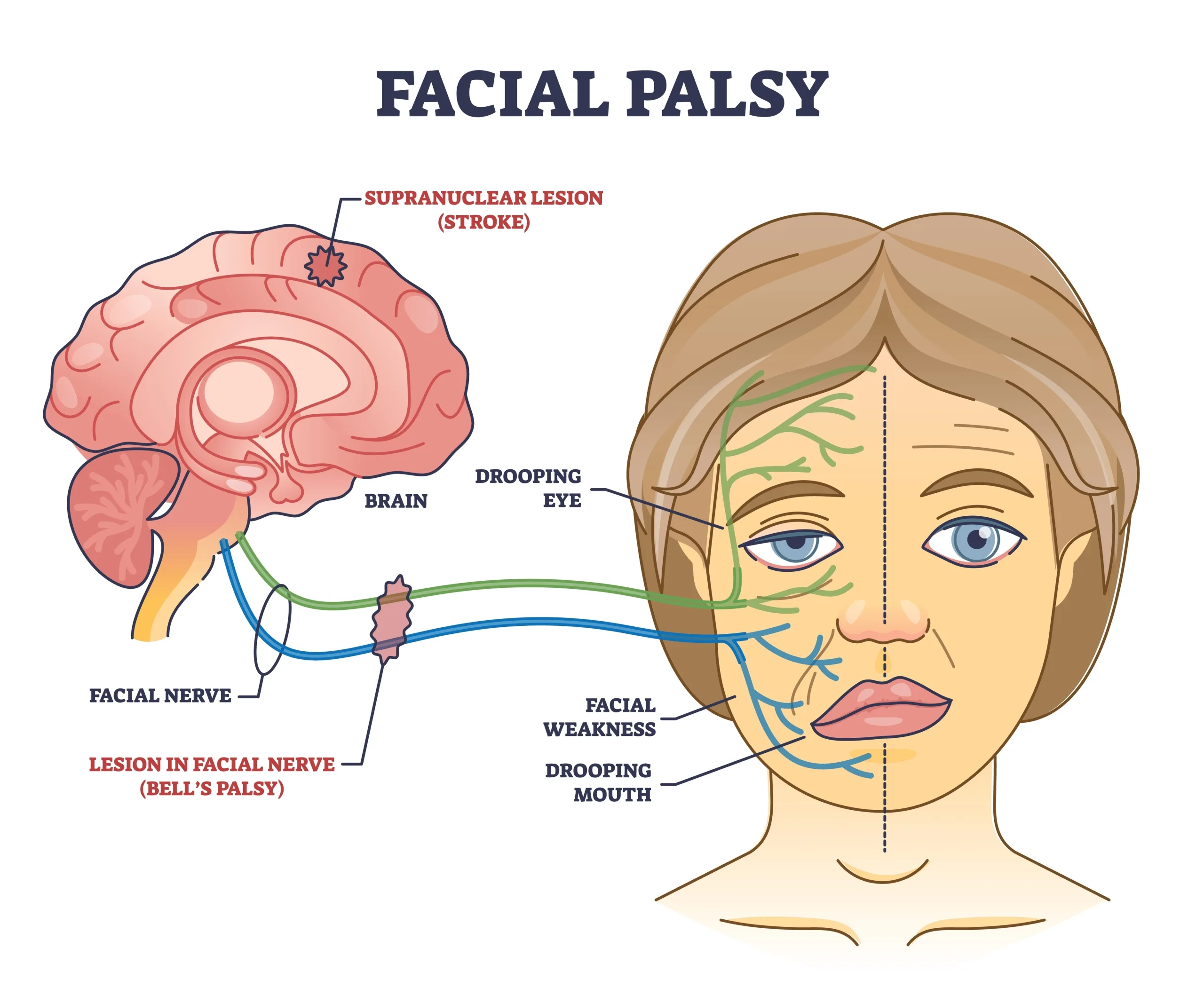 Bell’s Palsy / Facial Palsy