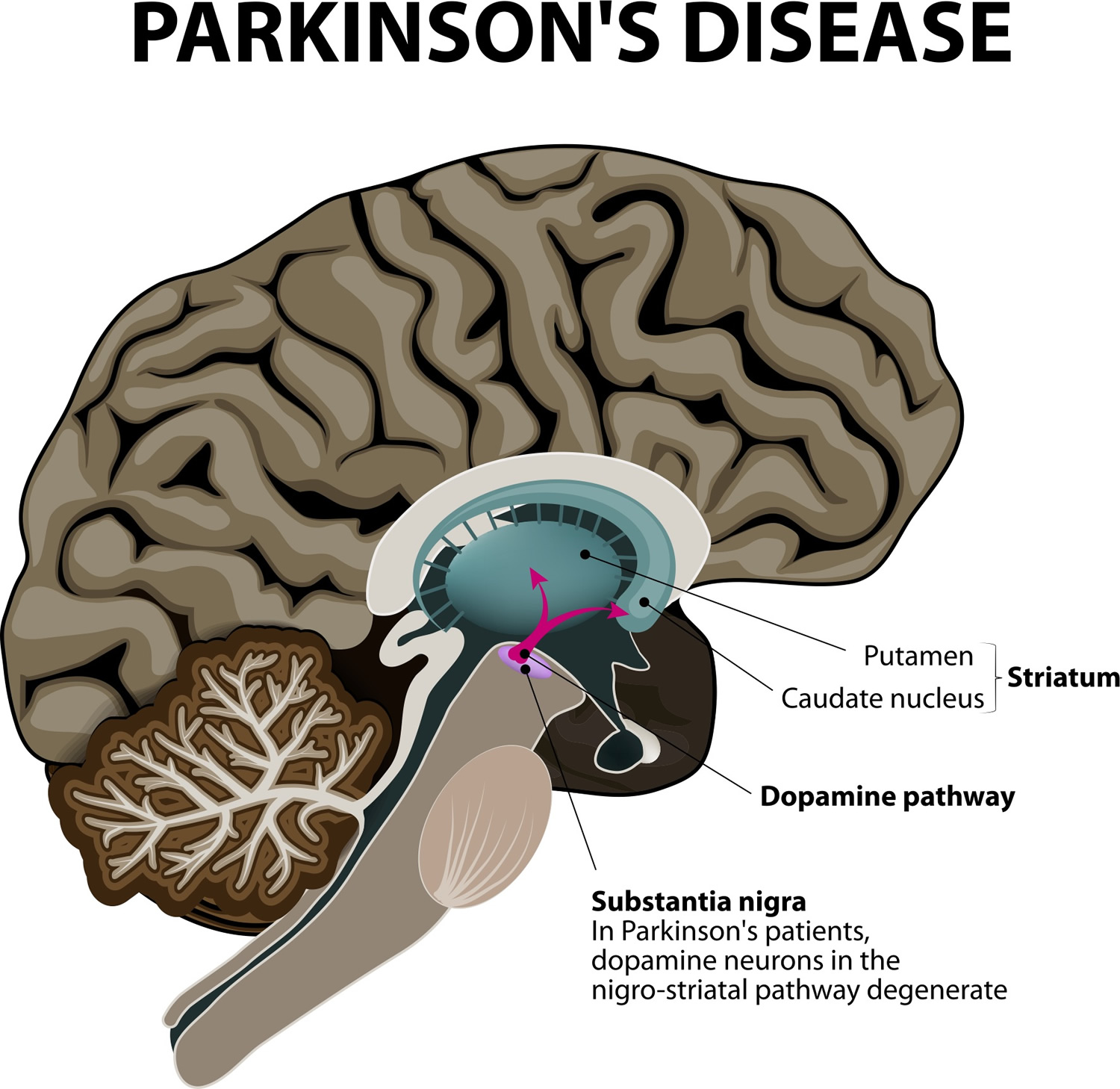 Parkinson’s Disease