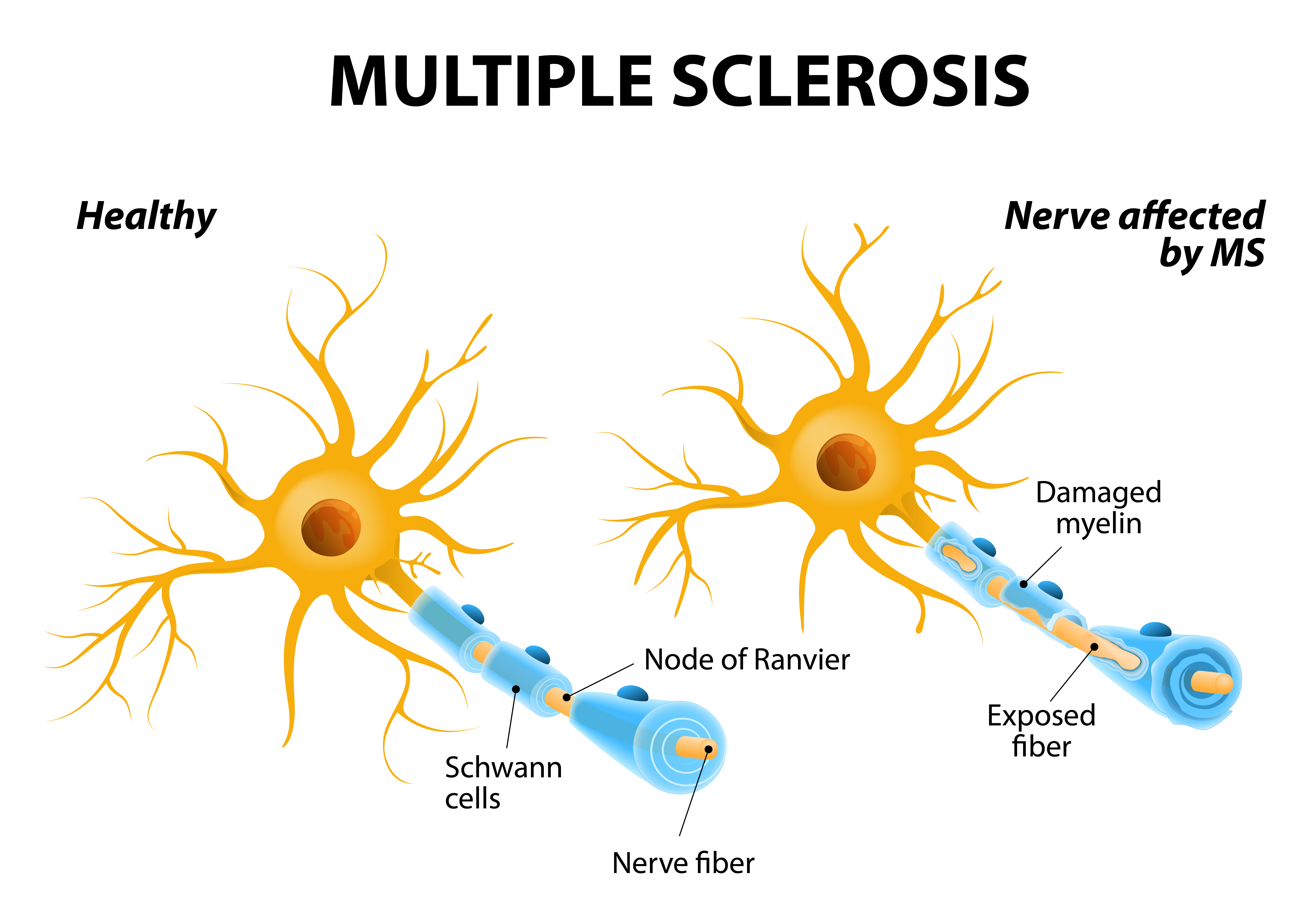 Multiple Sclerosis (MS)