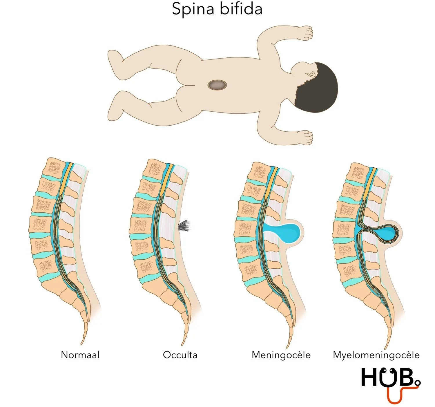 Spina Bifida