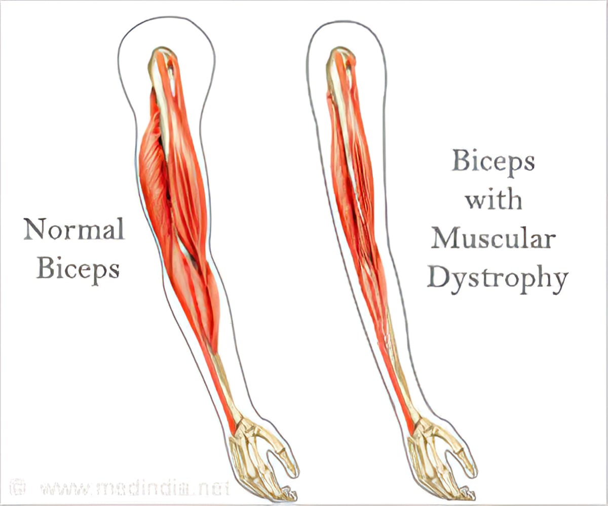 Muscular Dystrophy