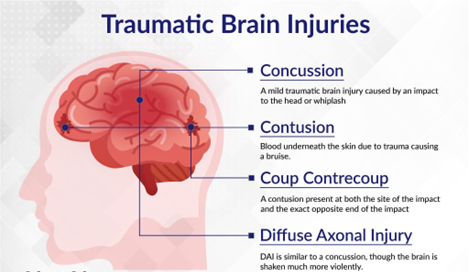 TBI (Traumatic Brain Injury)