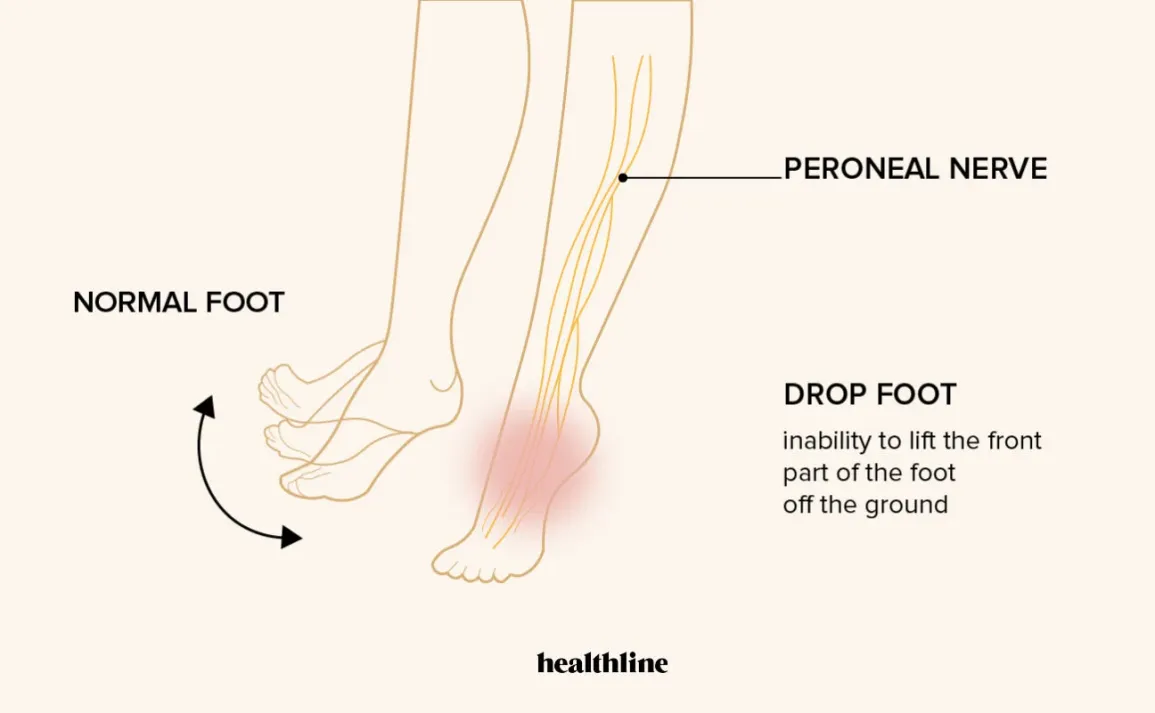 Foot Drop & Fatigue