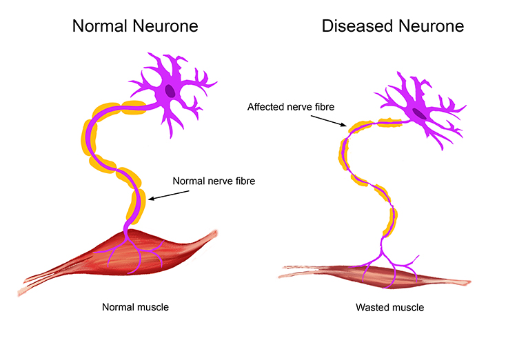 Motor Neuron Disease (MND)