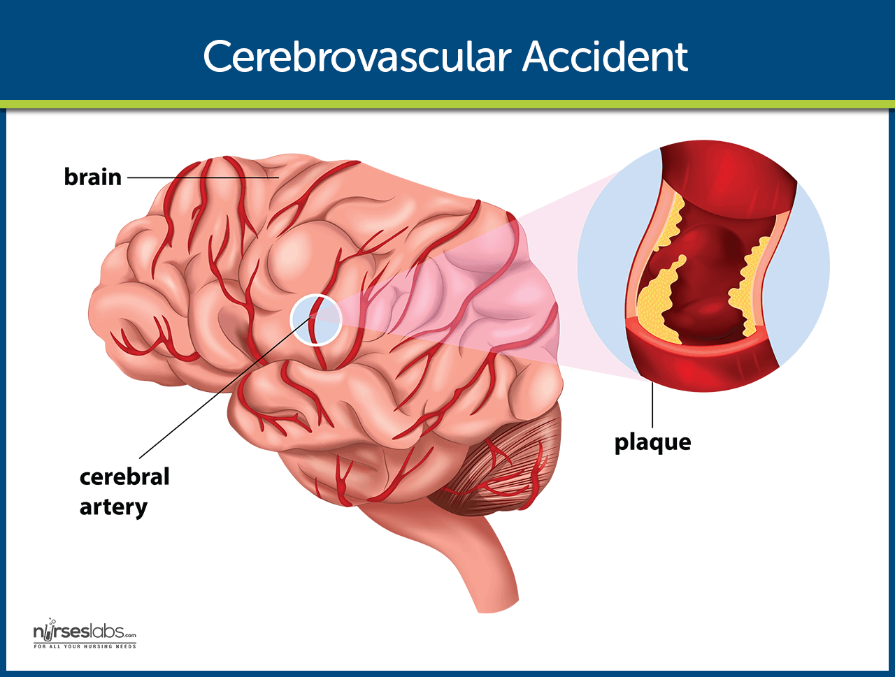 Cerebrovascular accident