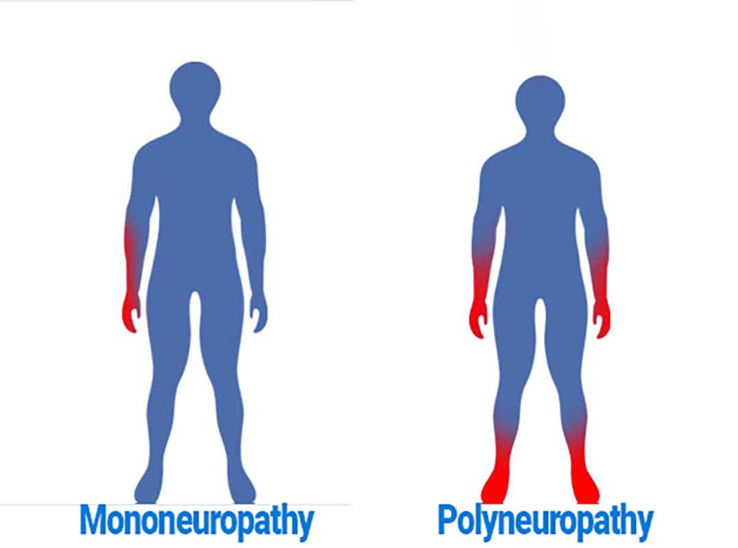 Polyneuropathies