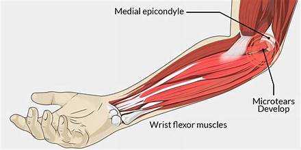 Tennis Elbow / Golfer’s Elbow