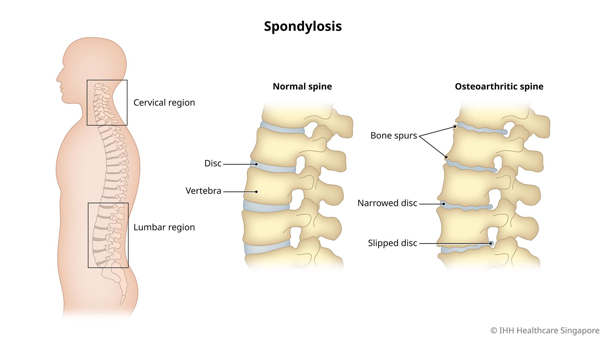 Cervical & Lumbar Spondylitis