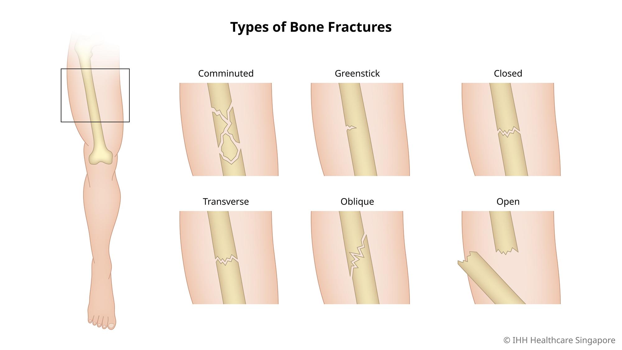 Bone Fracture