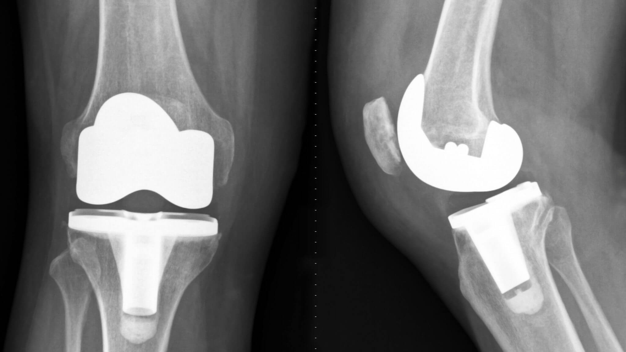 Total Knee Replacement (TKR)