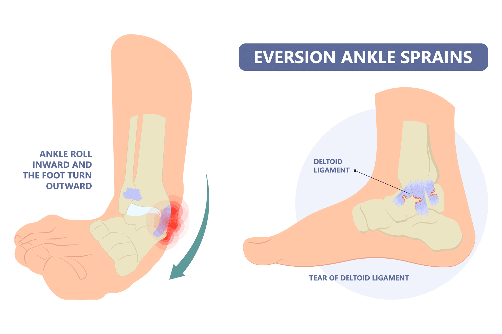 Ligament Sprain / Ankle Sprain