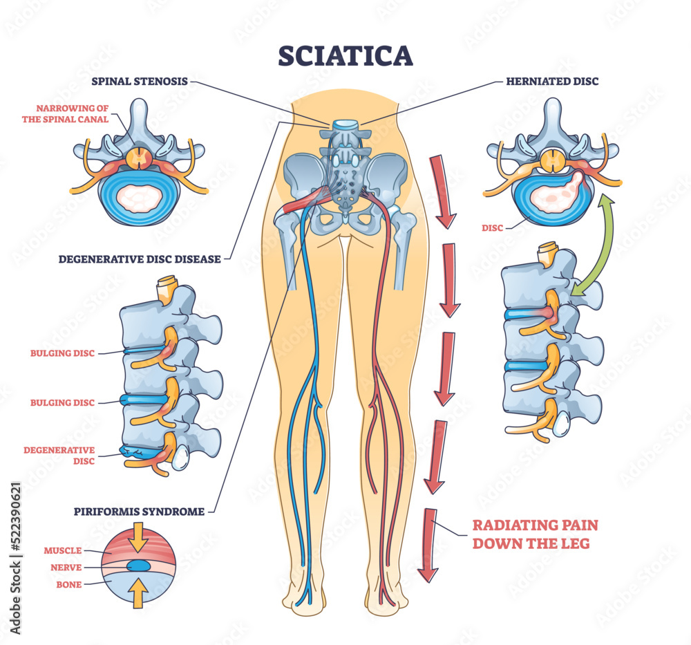 Sciatica