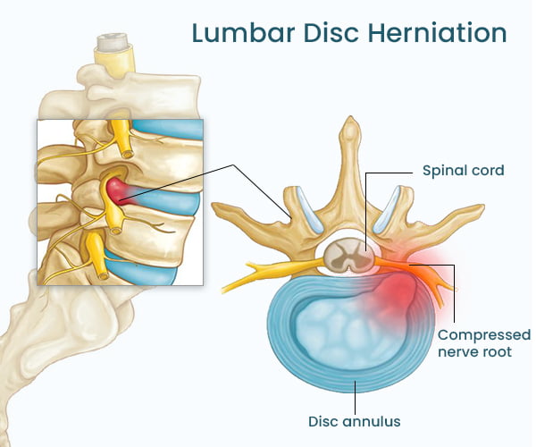 Lumbar Disc Herniation