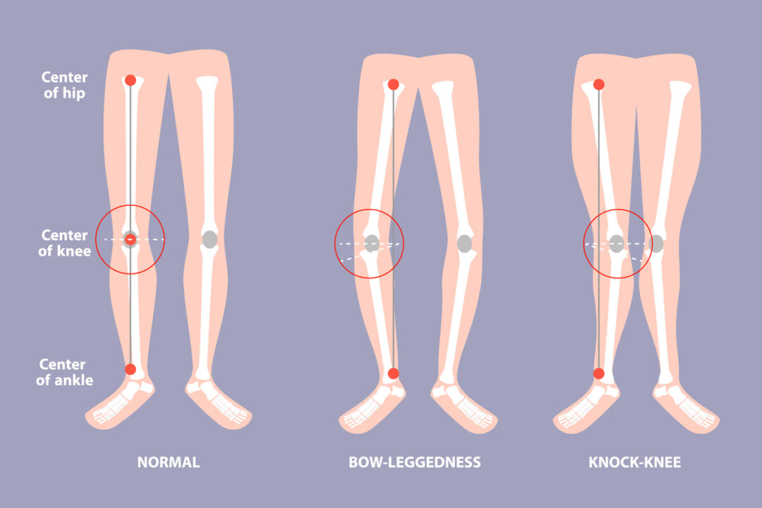 Bow Leg & Knock Knee