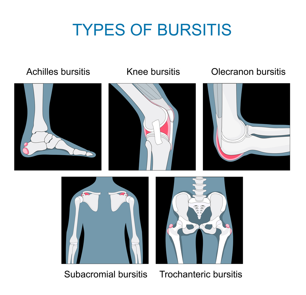 Bursitis
